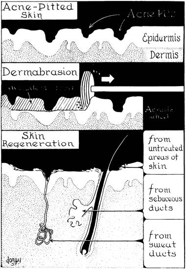 1960 Dermabrasion