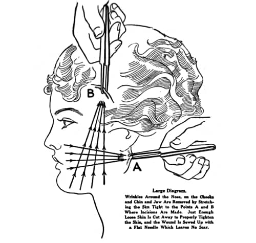 1920 diagram of a face lift