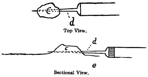 Electrolysis of a wart or mole